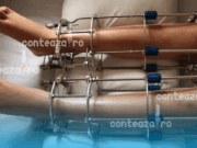 Fenomen periculos în Turcia: operațiile de alungire a picioarelor, noua obsesie estetică