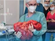 Șocant: Tumoare de 25 kg, eliminată chirurgical de la un pacient de 71 de ani la Cluj