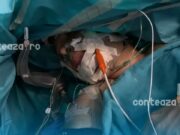 Premieră medicală în România: Operație pe creier cu pacientul complet conștient, realizată cu succes la Târgu Mureș