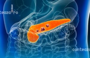 Inteligența artificială vede cancerul pancreatic cu peste un an înainte? Descoperirea care poate salva mii de vieți!